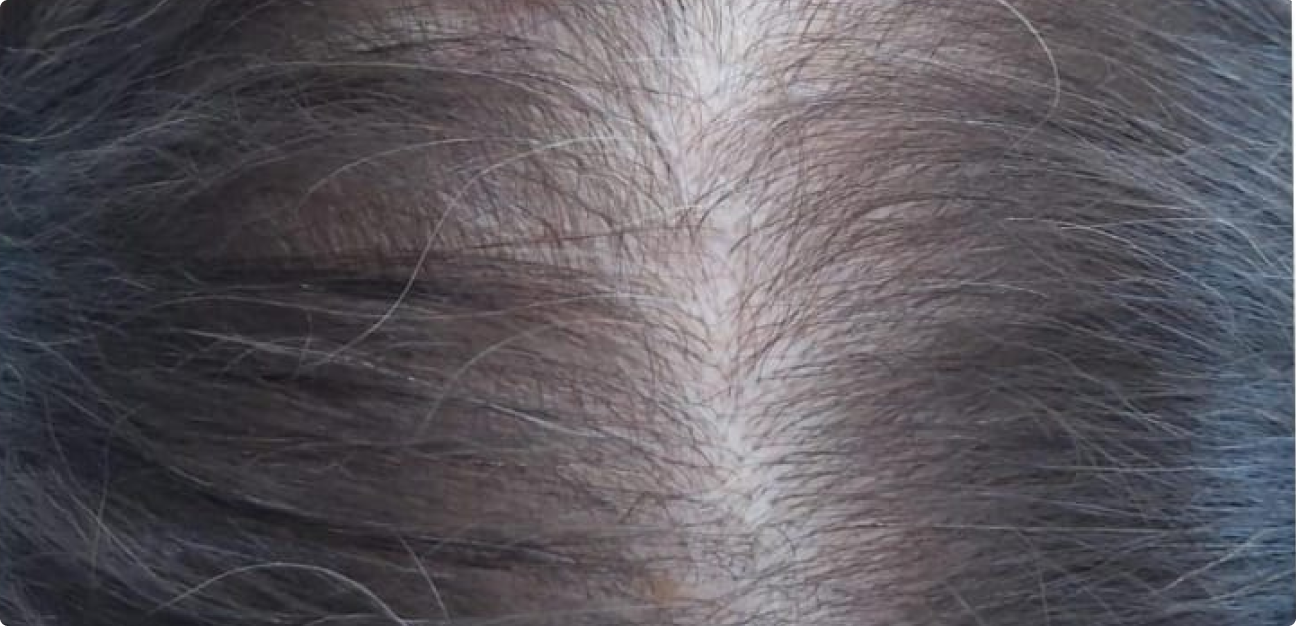 Couro Cabeludo com cabelo liso antes do procedimento realizado pela Tricologista Dra. Elaine Macedo