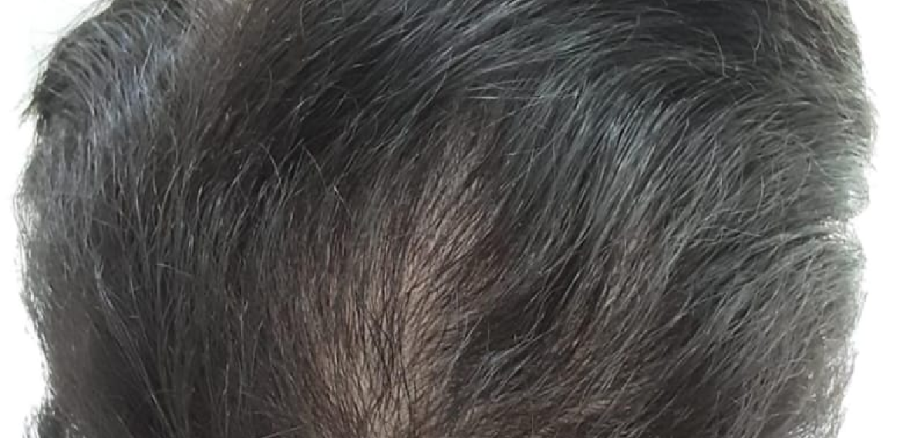 Couro Cabeludo com cabelo liso curto antes do procedimento realizado pela Tricologista Dra. Elaine Macedo