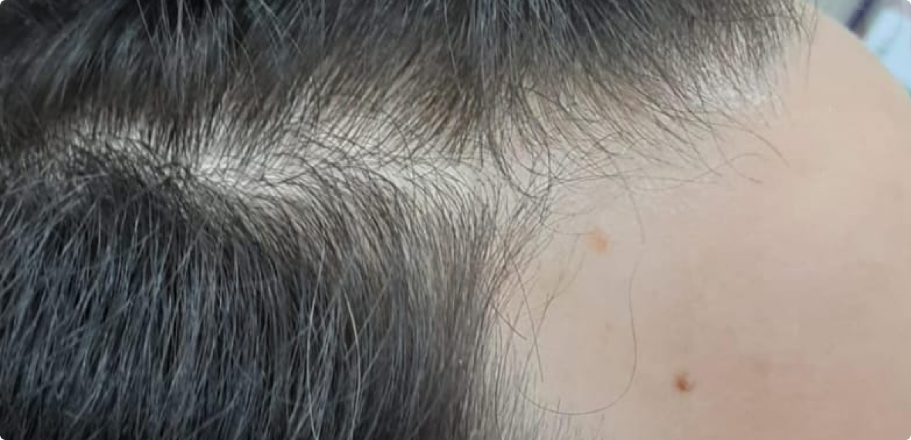 Couro Cabeludo com cabelo liso na parte frontal antes do procedimento realizado pela Tricologista Dra. Elaine Macedo