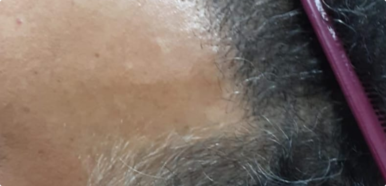 Couro Cabeludo com cabelo curto antes do procedimento realizado pela Tricologista Dra. Elaine Macedo