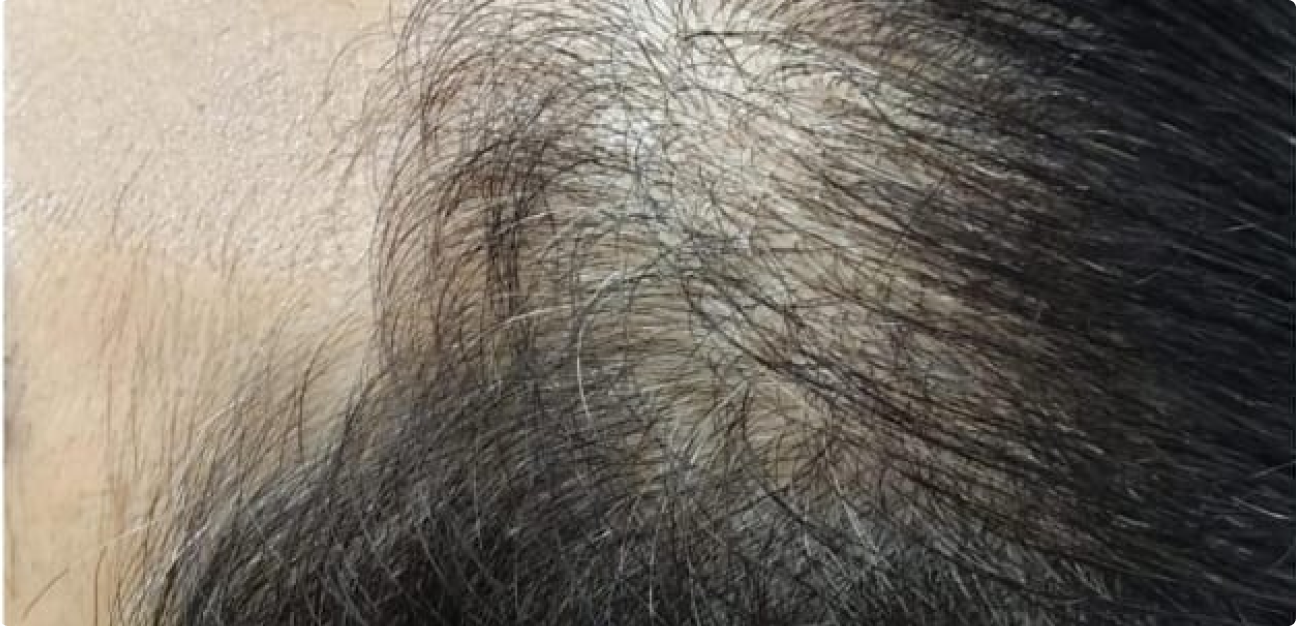 Couro Cabeludo com cabelo liso penteado antes do procedimento realizado pela Tricologista Dra. Elaine Macedo