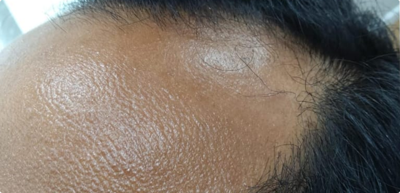 Couro Cabeludo com cabelo preto antes do procedimento realizado pela Tricologista Dra. Elaine Macedo