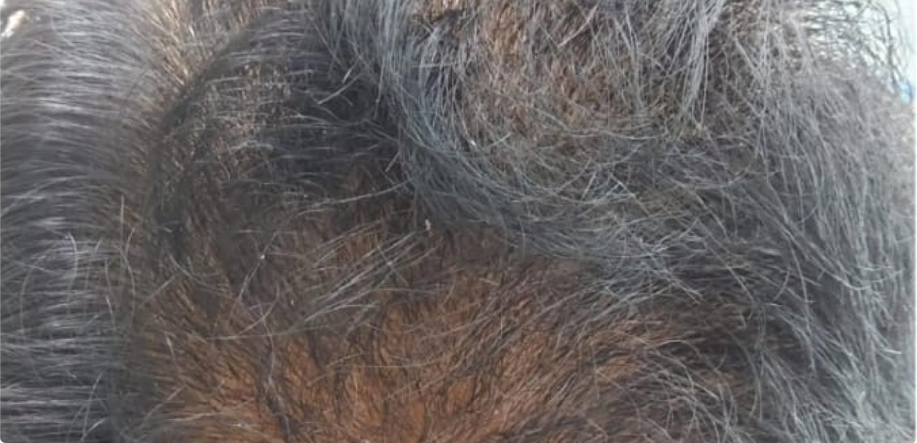 Couro Cabeludo com cabelo grisalho antes do procedimento realizado pela Tricologista Dra. Elaine Macedo