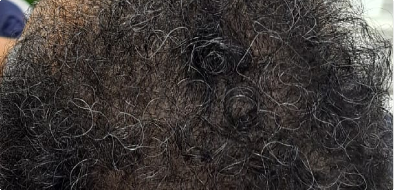 Couro Cabeludo com cabelo cacheado depois do procedimento realizado pela Tricologista Dra. Elaine Macedo