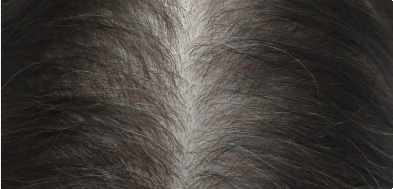 Couro Cabeludo com cabelo liso depois do procedimento realizado pela Tricologista Dra. Elaine Macedo