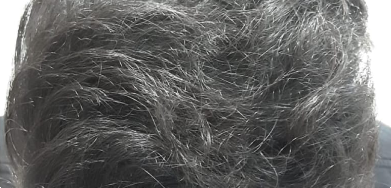 Couro Cabeludo com cabelo preto depois do procedimento realizado pela Tricologista Dra. Elaine Macedo