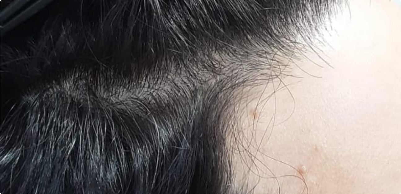 Couro Cabeludo com cabelo liso penteado depois do procedimento realizado pela Tricologista Dra. Elaine Macedo