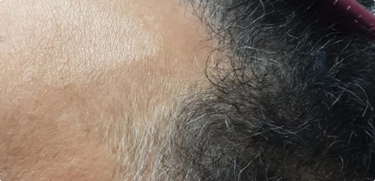 Couro Cabeludo com cabelo curto depois do procedimento realizado pela Tricologista Dra. Elaine Macedo