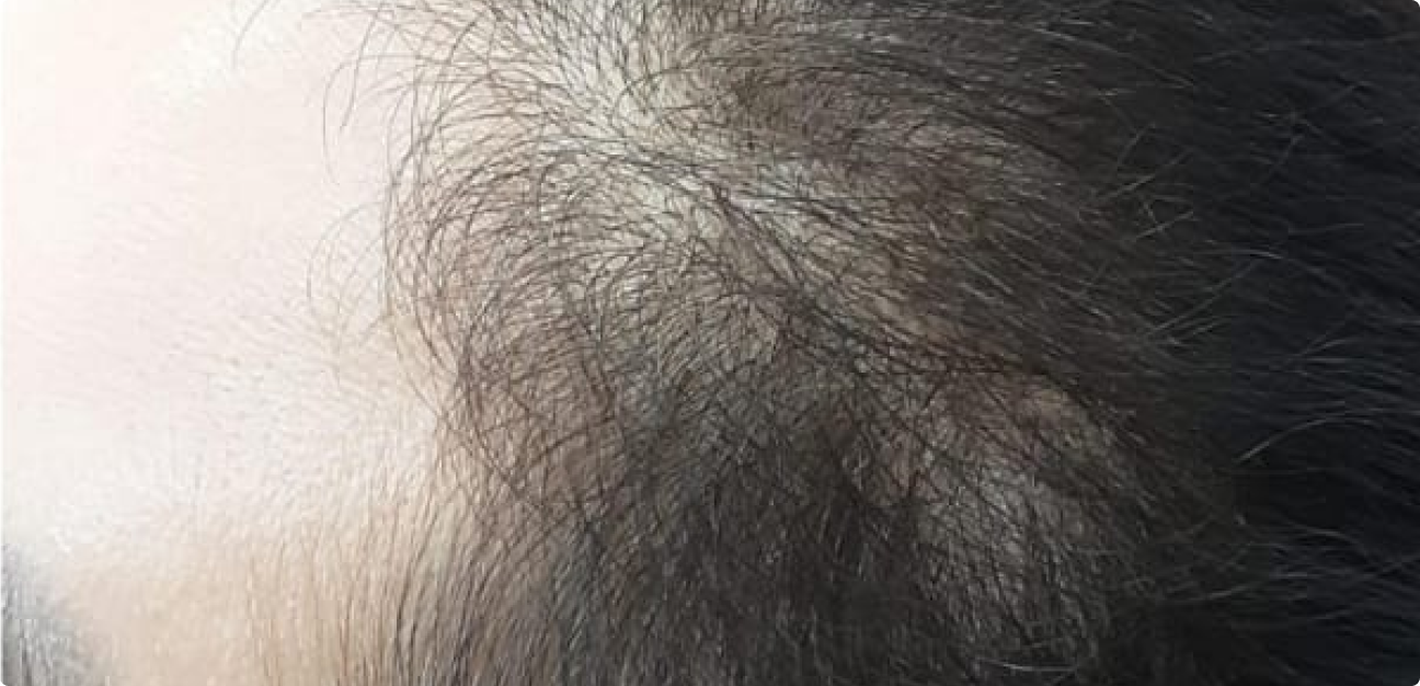 Couro Cabeludo com cabelo liso preto depois do procedimento realizado pela Tricologista Dra. Elaine Macedo