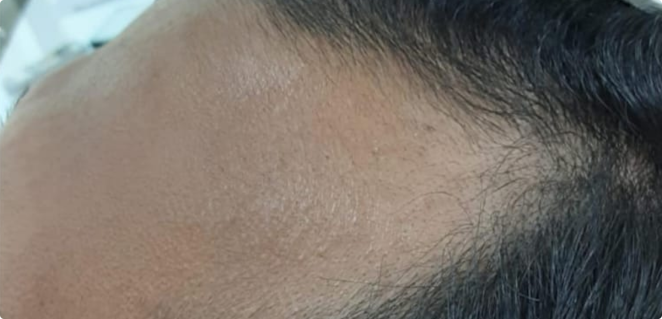 Couro Cabeludo com cabelo castanho escuro depois do procedimento realizado pela Tricologista Dra. Elaine Macedo