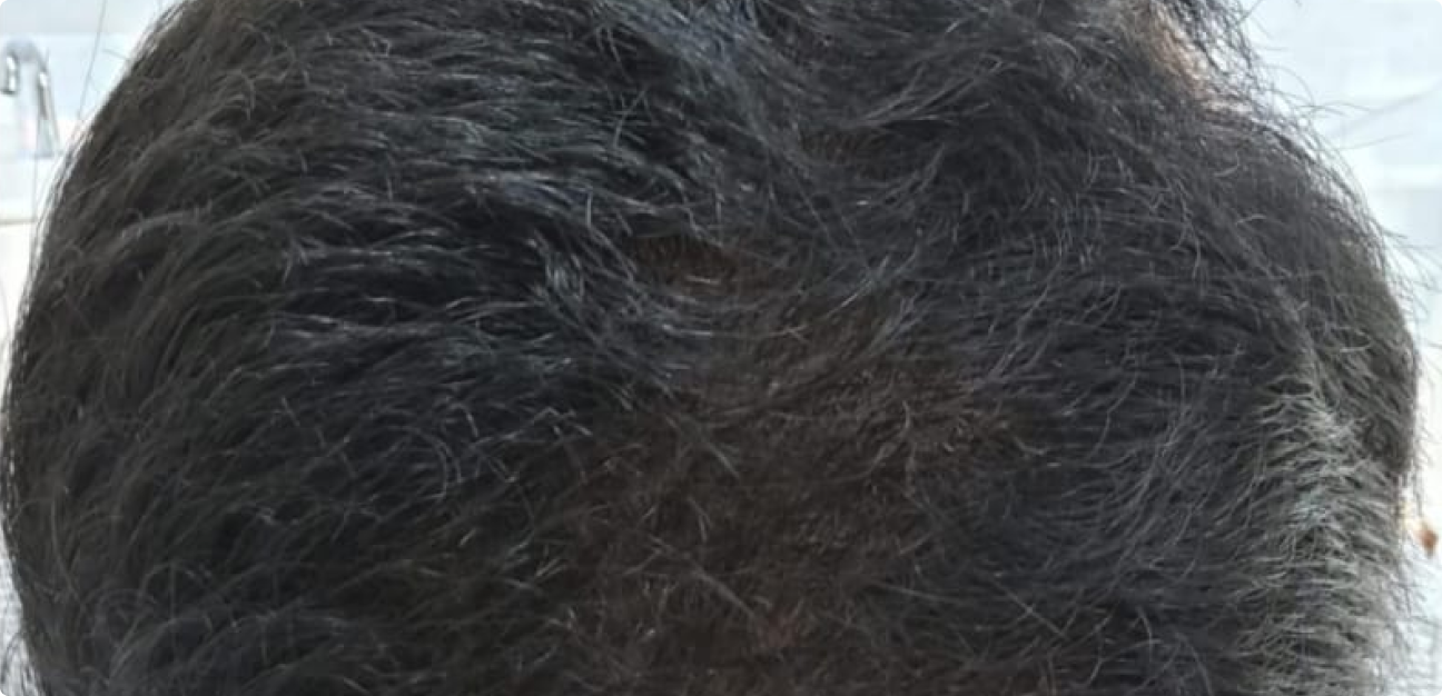 Couro Cabeludo com cabelo castanho escuro liso depois do procedimento realizado pela Tricologista Dra. Elaine Macedo